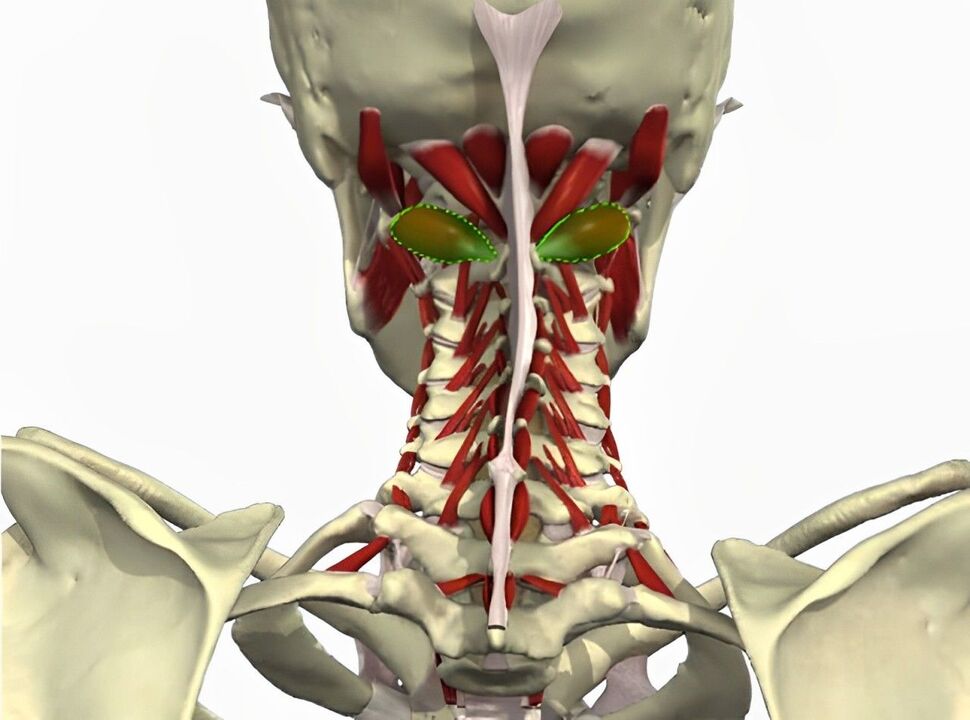 синдроми артерияи vertebral